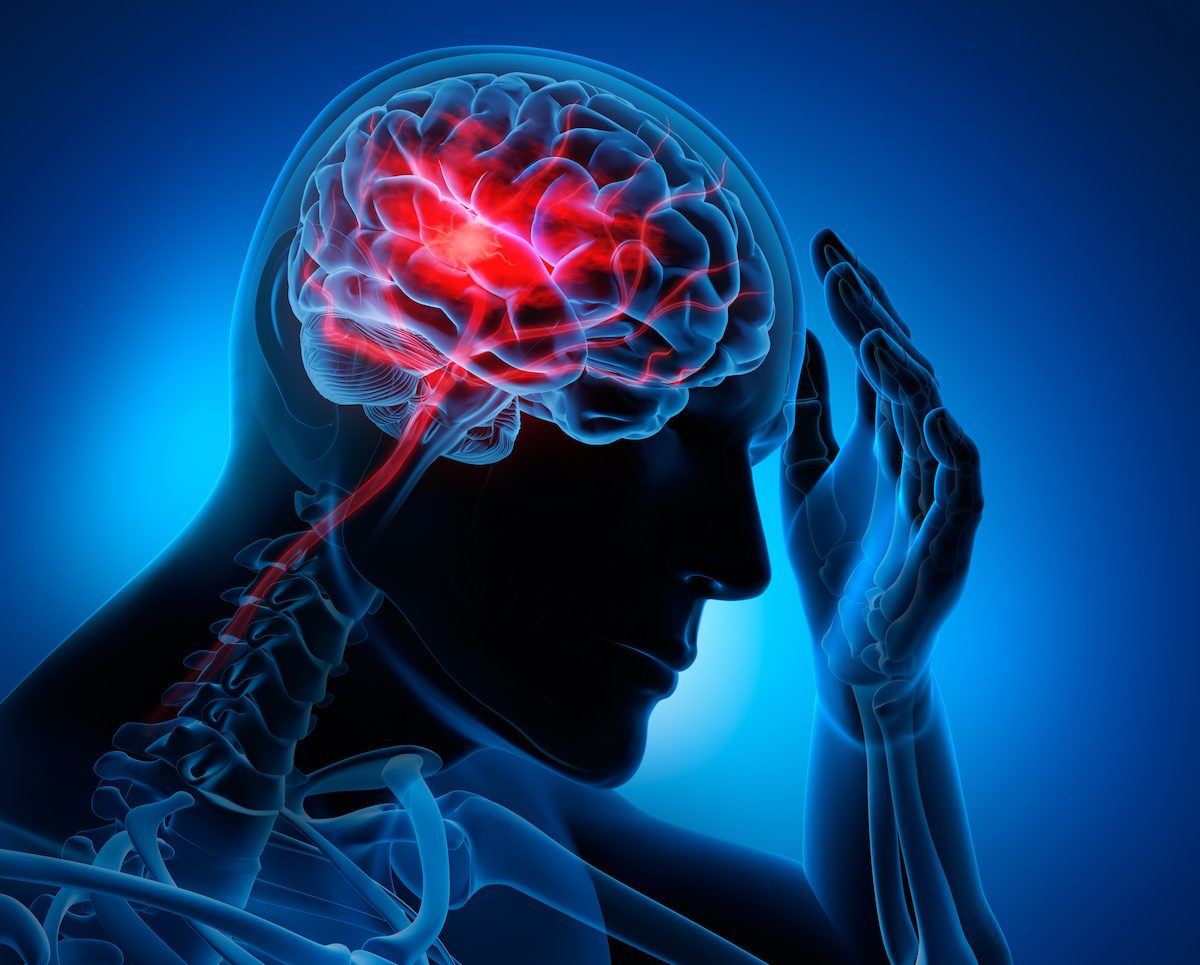 Riesgos de una hemorragia cerebral