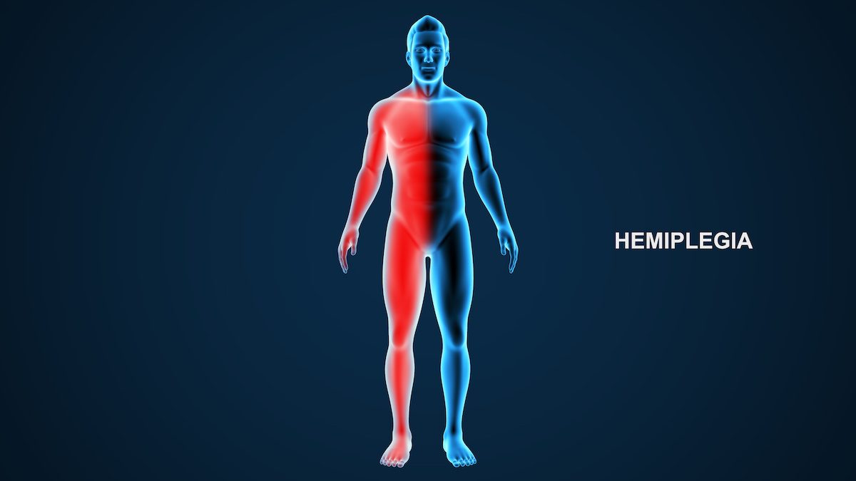Causas comunes de hemiplejia